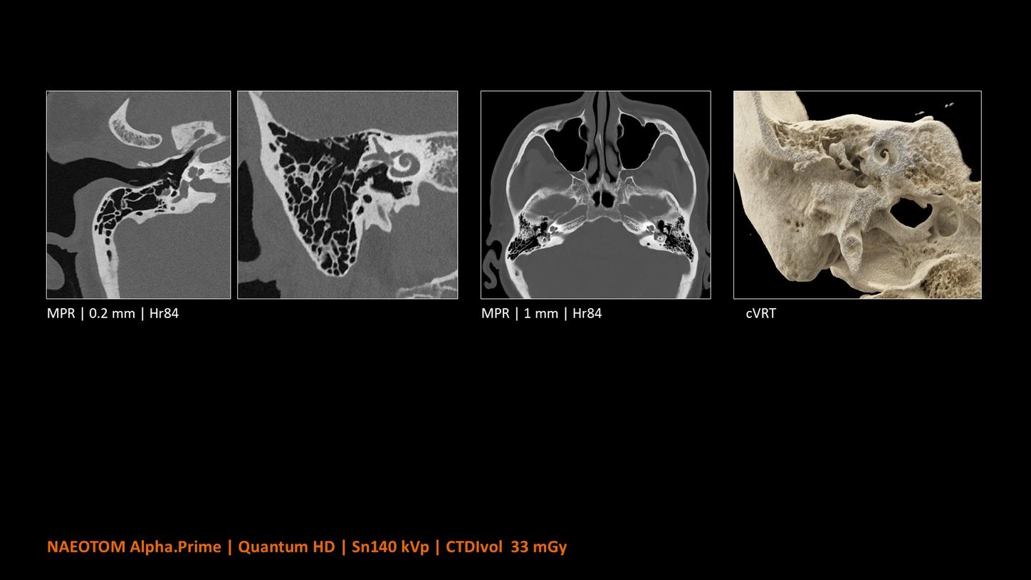 High-resolution CT images of the temporal bone and inner ear, including a 3D rendering of the skull base.