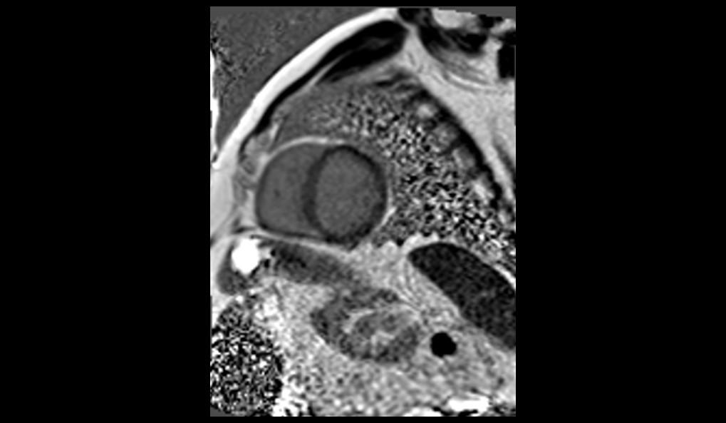 CT image of retro-ocular masses causing exophthalmos along with bilateral perinephric, pericardial, and pelvic exudates