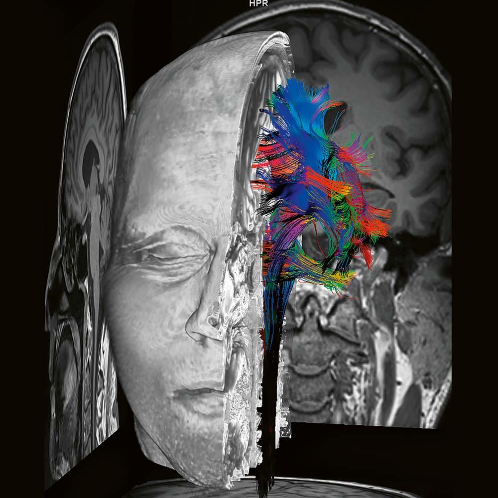 Siemens Healthineers Biomatrix MRI DTI fibertracking