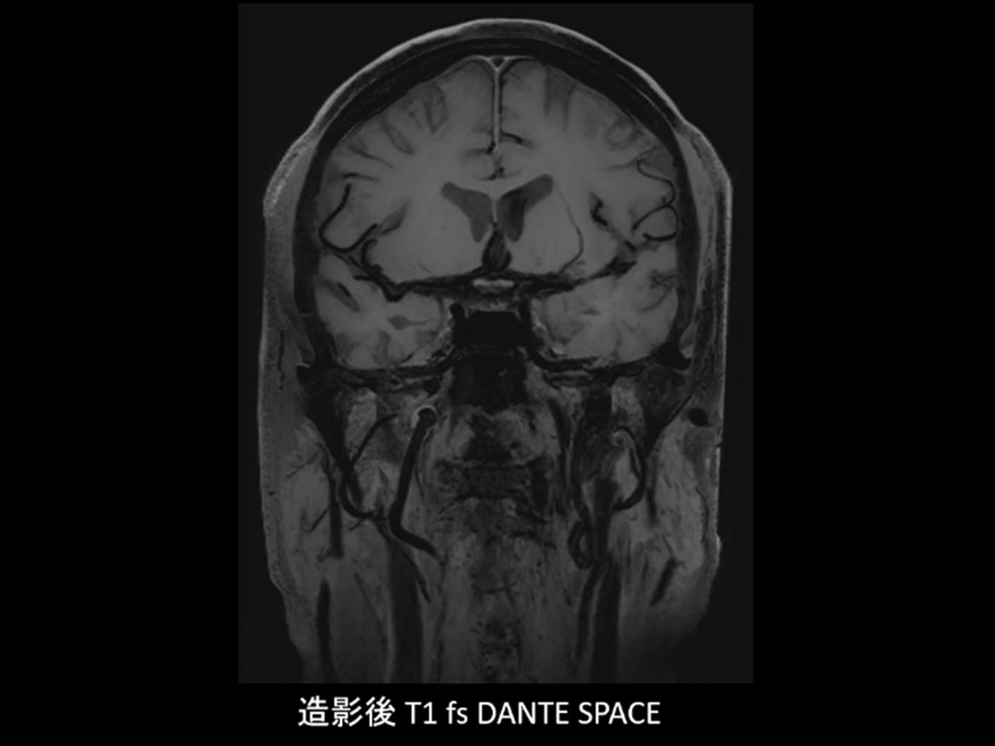造影後T1 fs DANTE SPACE