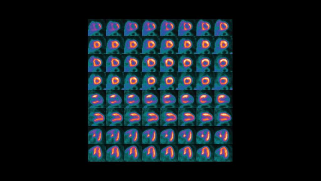 PET/CT delineation of multivessel coronary artery disease and post ...