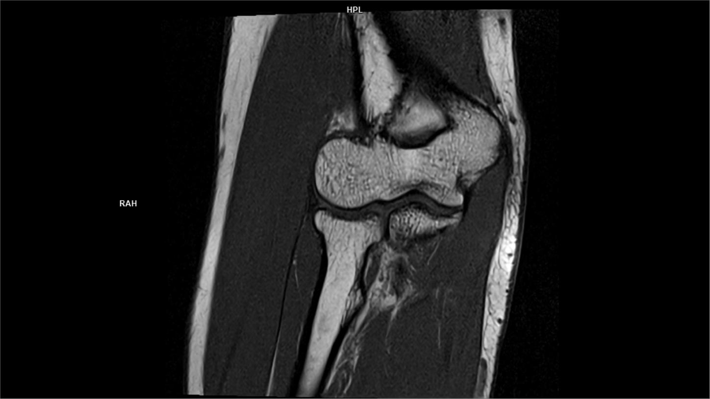 Coronal T1-MAGNETOM Free.Max/Coil-Contour/Resolution-512/Scan Time-2:00/Aceleration-s2 DRS
