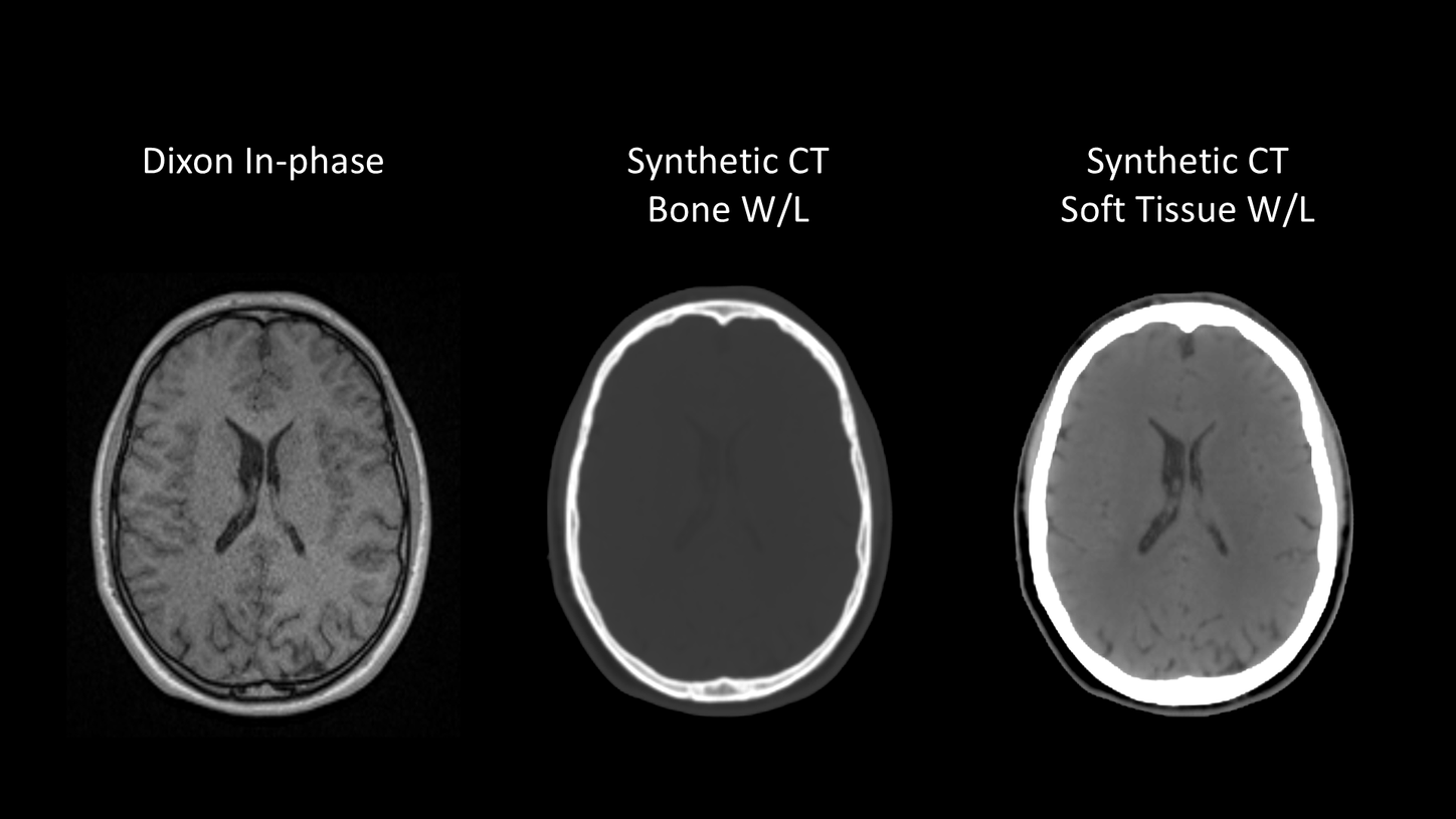DI MR Vartis Synthetic CT MR-only Brain