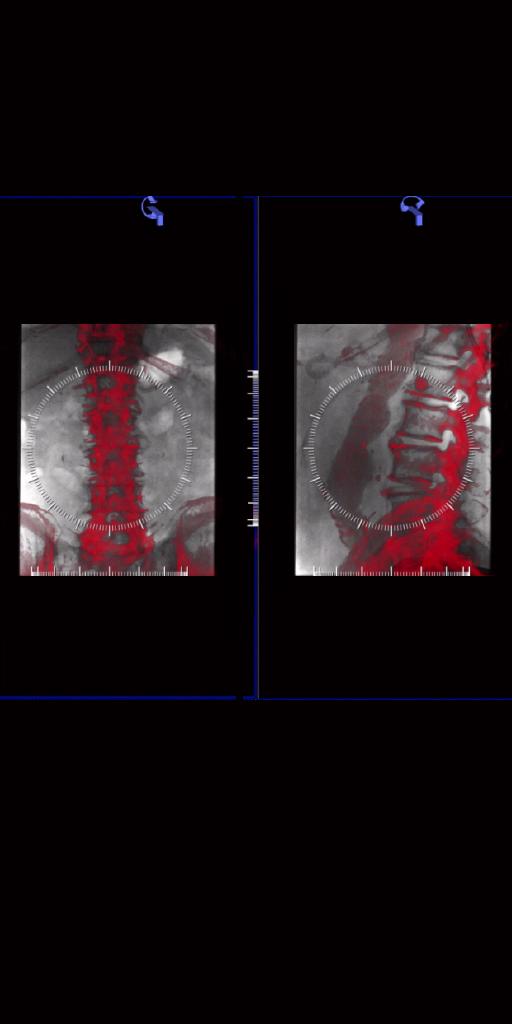 Clinical image showing registration of the pre-interventional CTA with the C-arm geometry using syngo 2D/3D Fusion