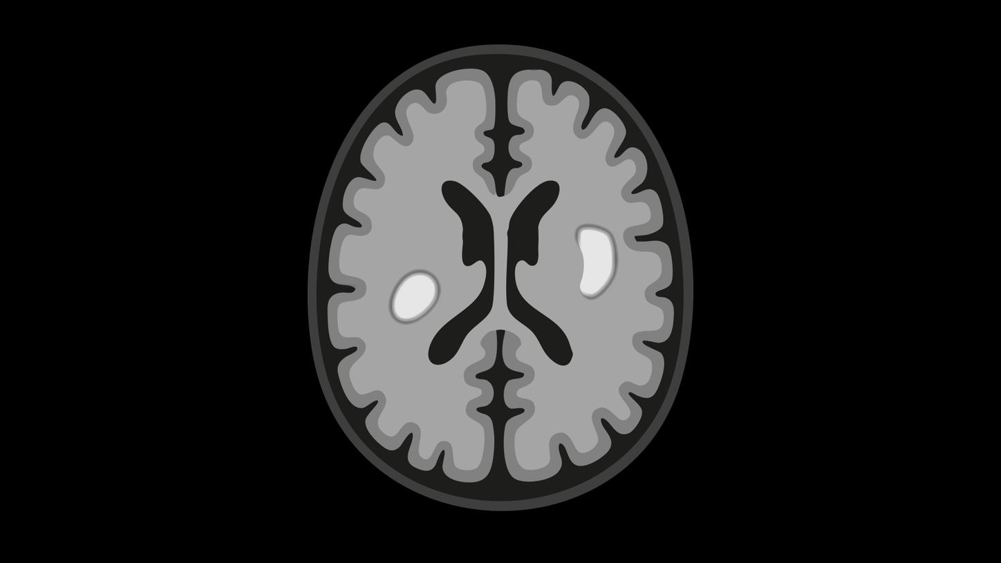 Paramagnetic Rim Lesions (PRLs)