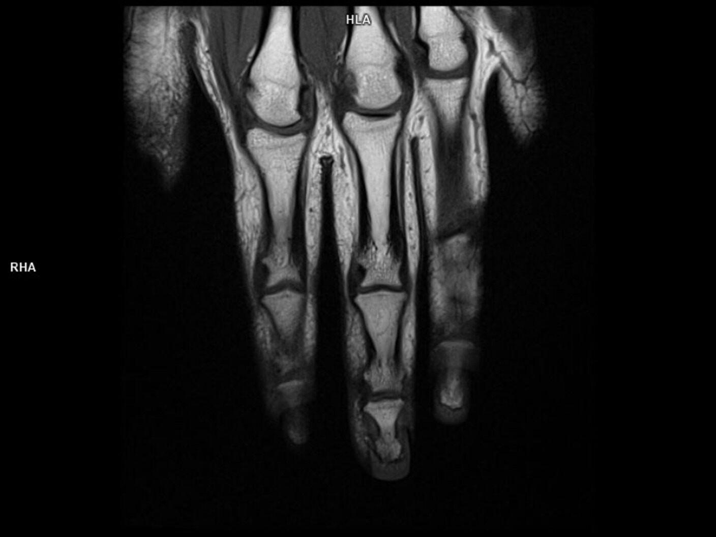 Coronal T1 TSE-MAGNETOM Lumina