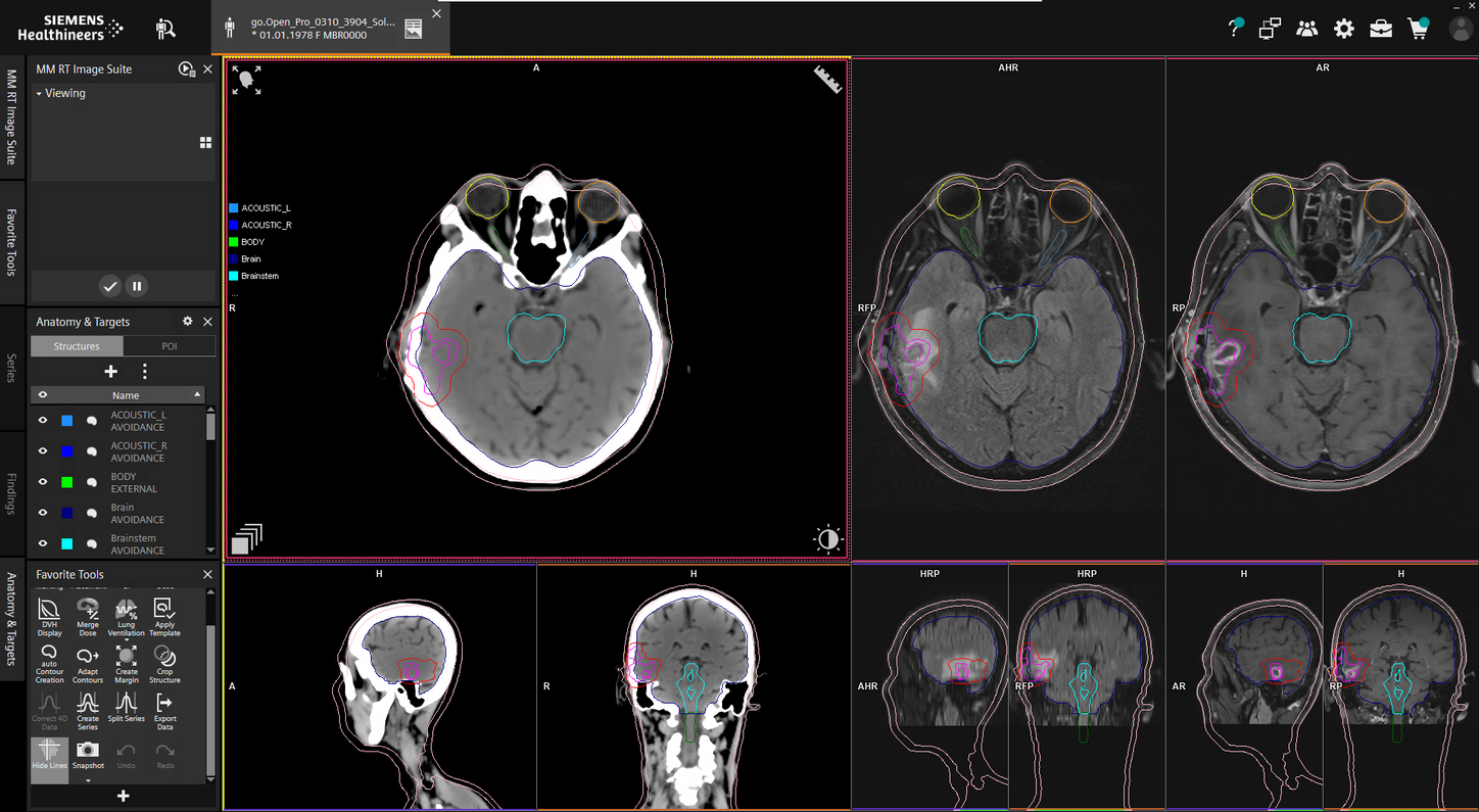 Synthetic CT - Contouring