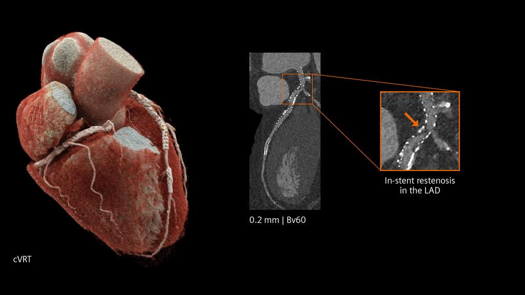 PCCT cardiovascular imaging - Siemens Healthineers