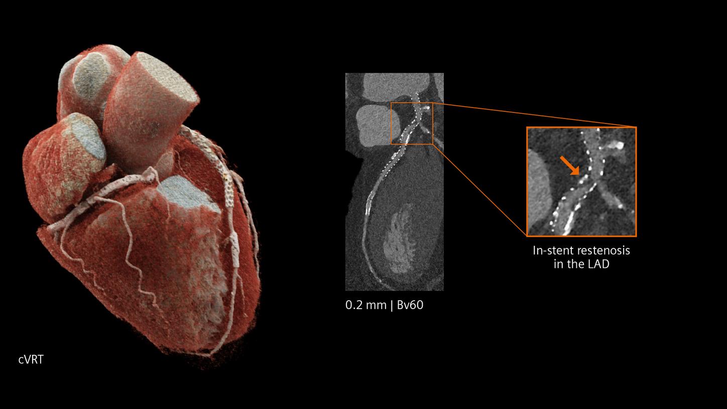 Cardiac CT showing in-stent restenosis in the LAD, highlighted with a zoomed-in view and 3D heart model.