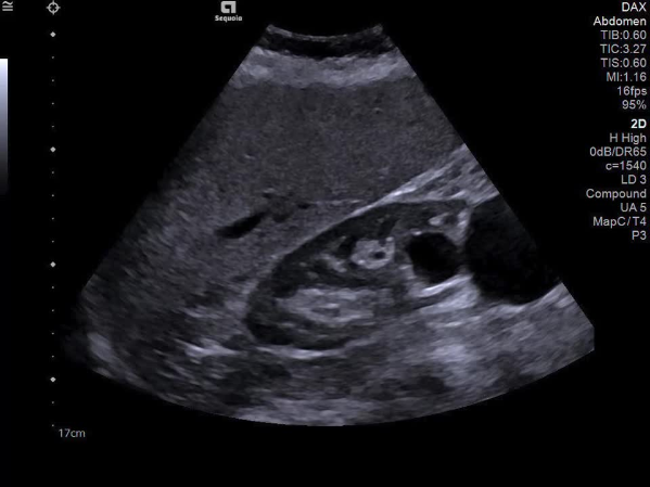 Liver ultrasound with the DAX transducer
