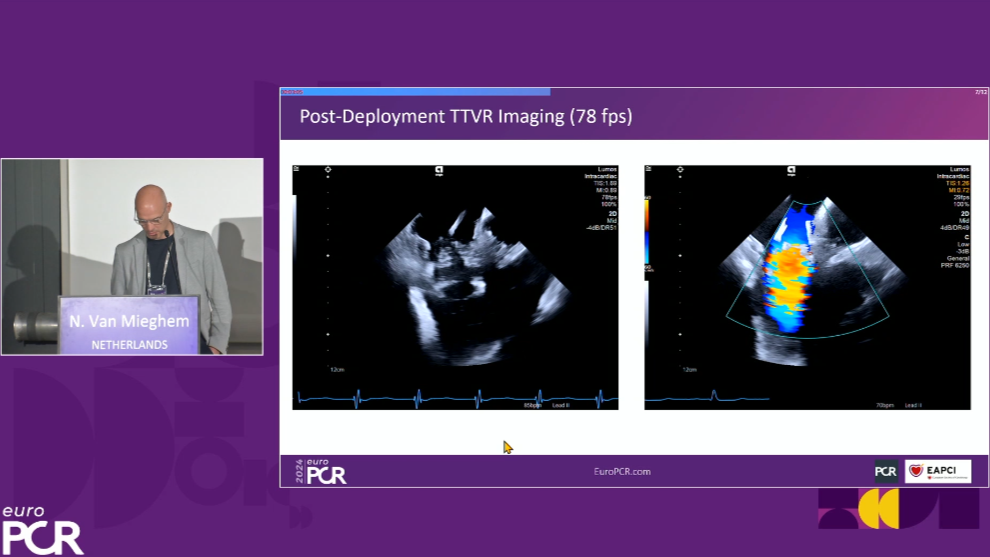 AT CVC euroPCR2024 transcatheter tricuspid valve interventions