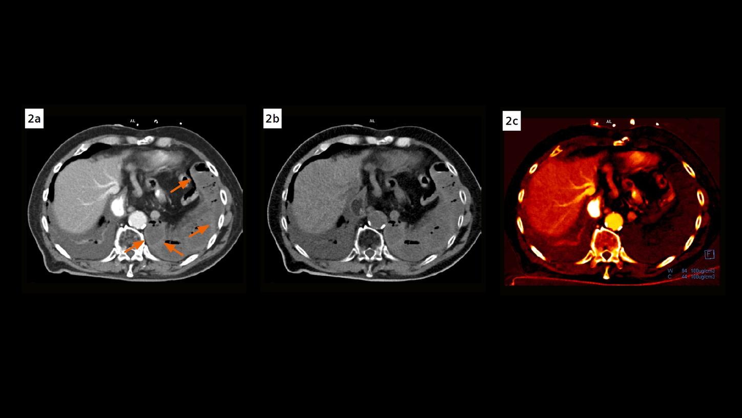 A contrast enhanced axial image shows a thin rim of hyperdensity within the wall of the herniated bowel loops, which are also seen in the VNC image, but not seen in the iodine map, suggesting submucosal hemorrhage, compatible with infarction.