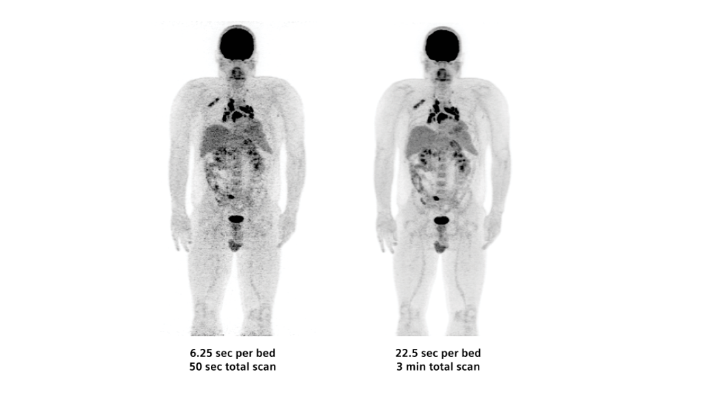 Biograph Vision clinical case