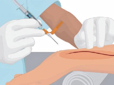 血液ガス分析かわら版②採血