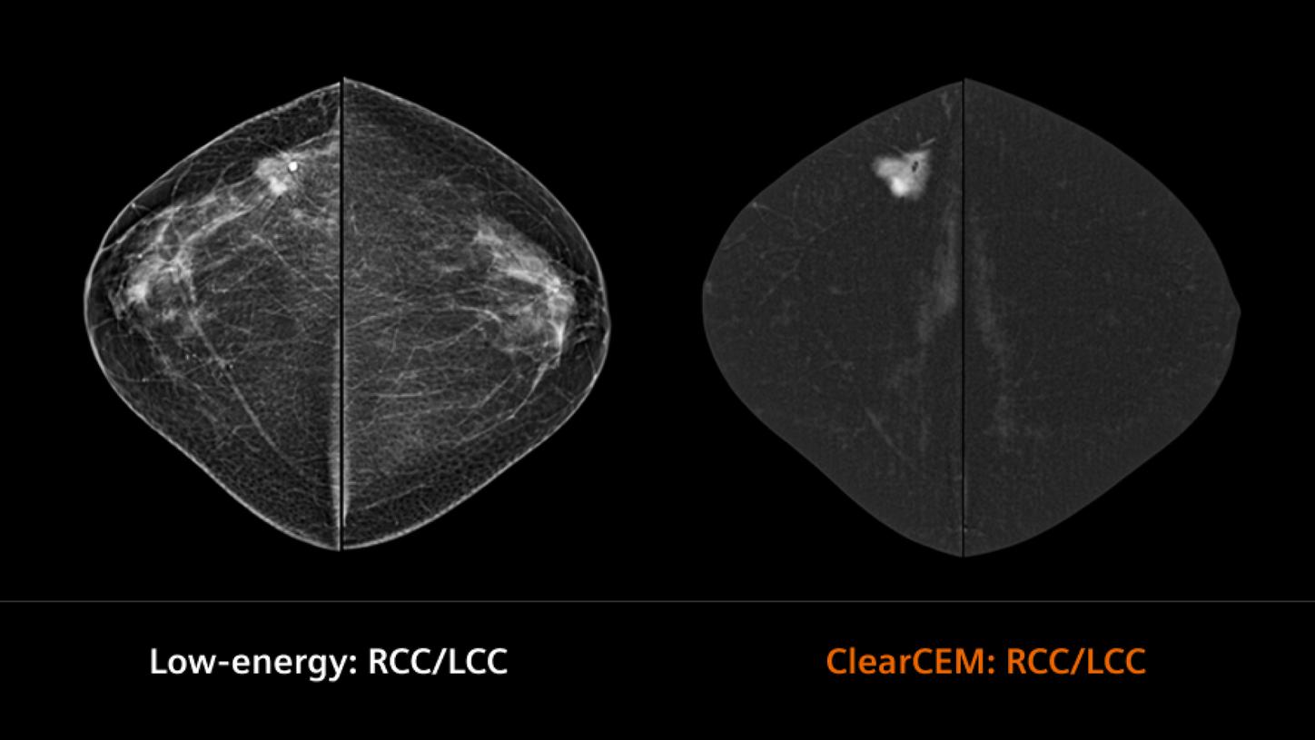 Clinical image breast
