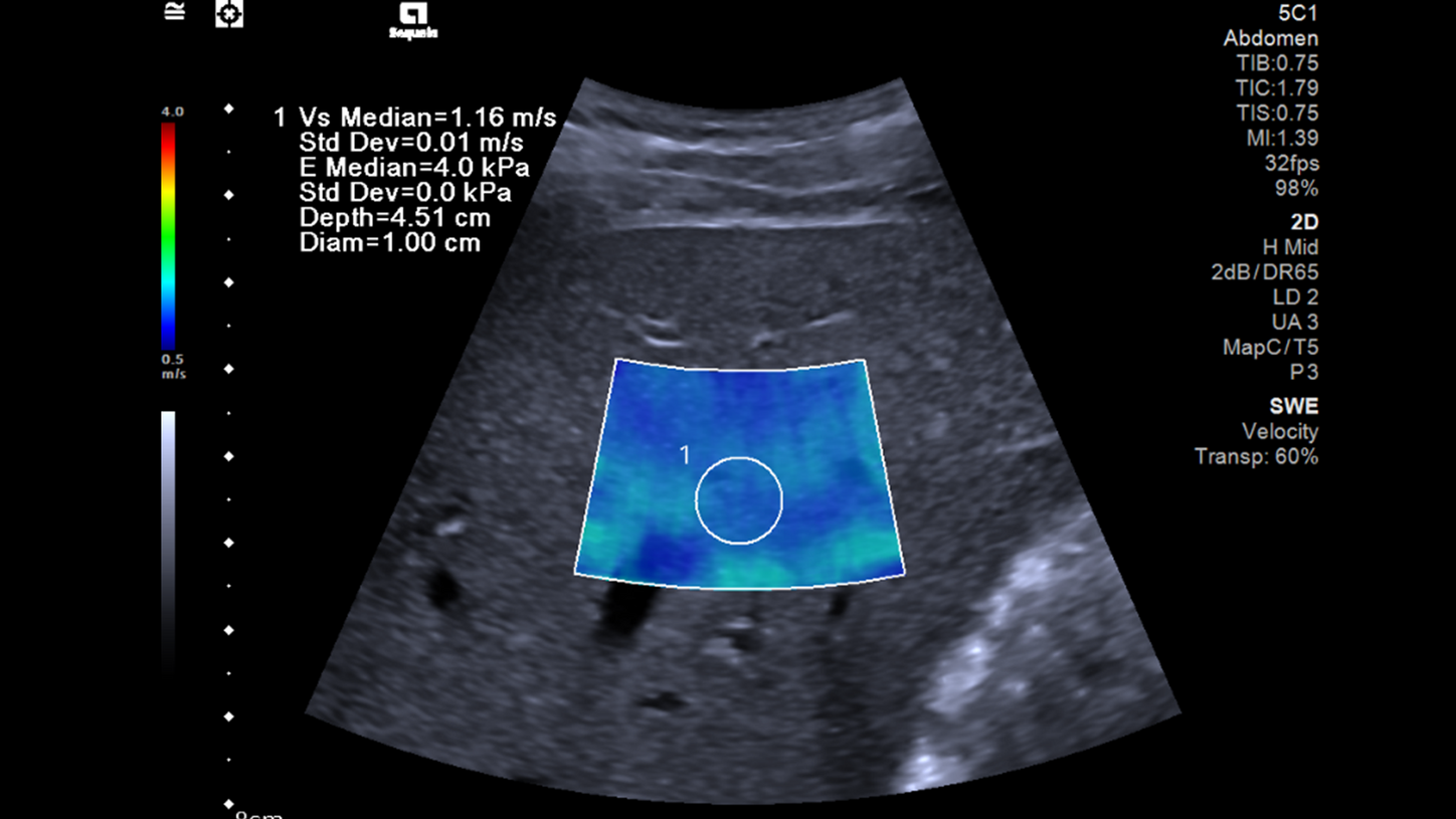 2D-Scherwellen-Elastographie