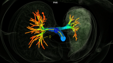 Fig. 3: syngo.via Pulmo 3D airway reconstruction demonstrating compression of the left bronchial tree.