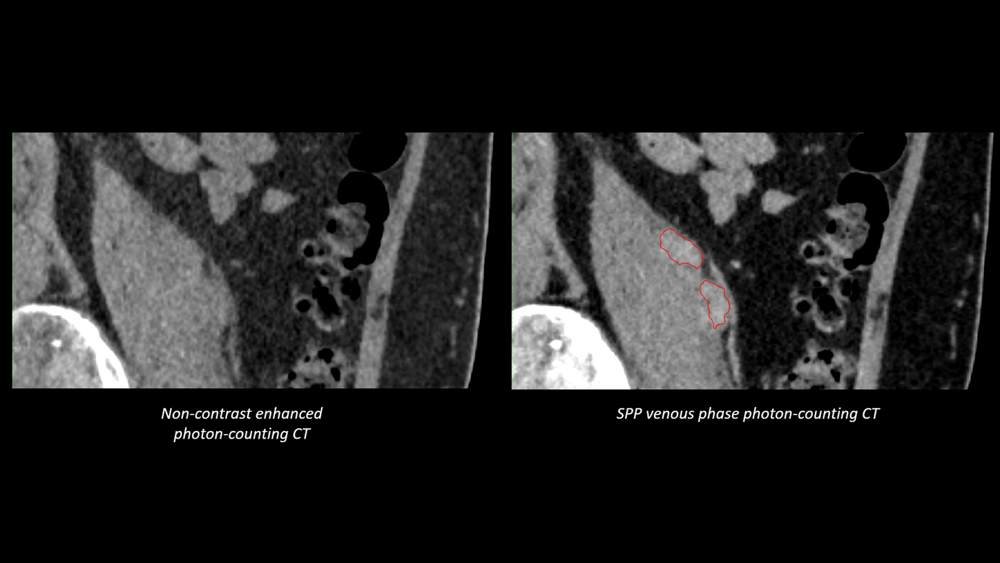 Intramuscular Lesions