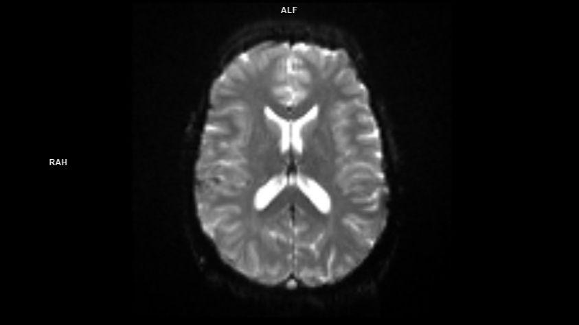 epfid2D FS AX Hemo-MAGNETOM Sola/Coil-HeadNeck 20/Resolution-128/Scan Time-1:50