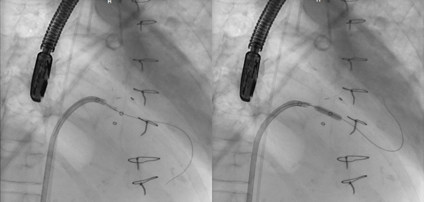 BATMAN (Balloon-Assisted Translocation of the Anterior Mitral leaflet to prevent Neo-LVOT obstruction) technique