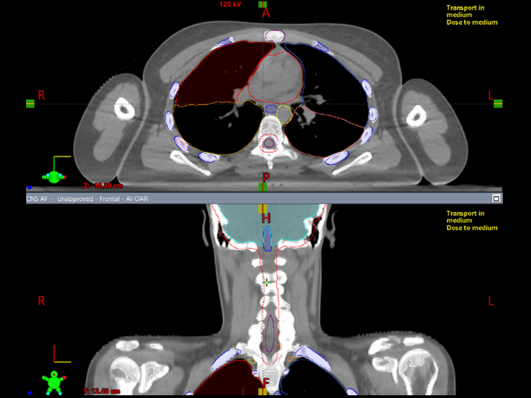 artificial intelligence in radiotherapy