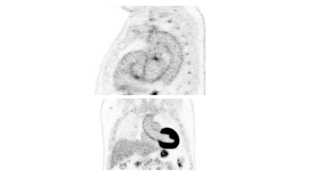 Biograph Vision clinical case