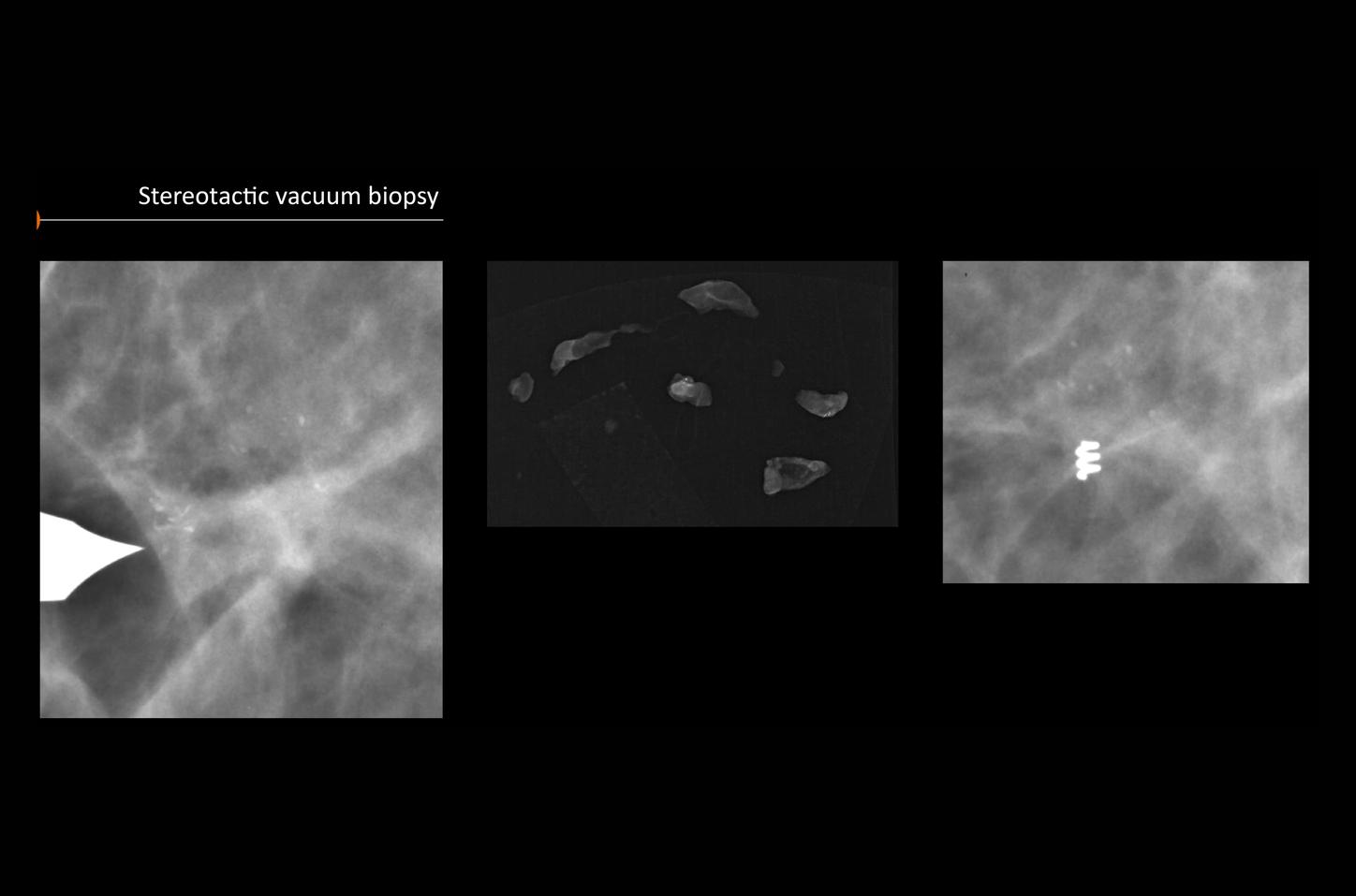 Microcalcificaciones mamarias benignas asociadas a cambios fibroquísticos