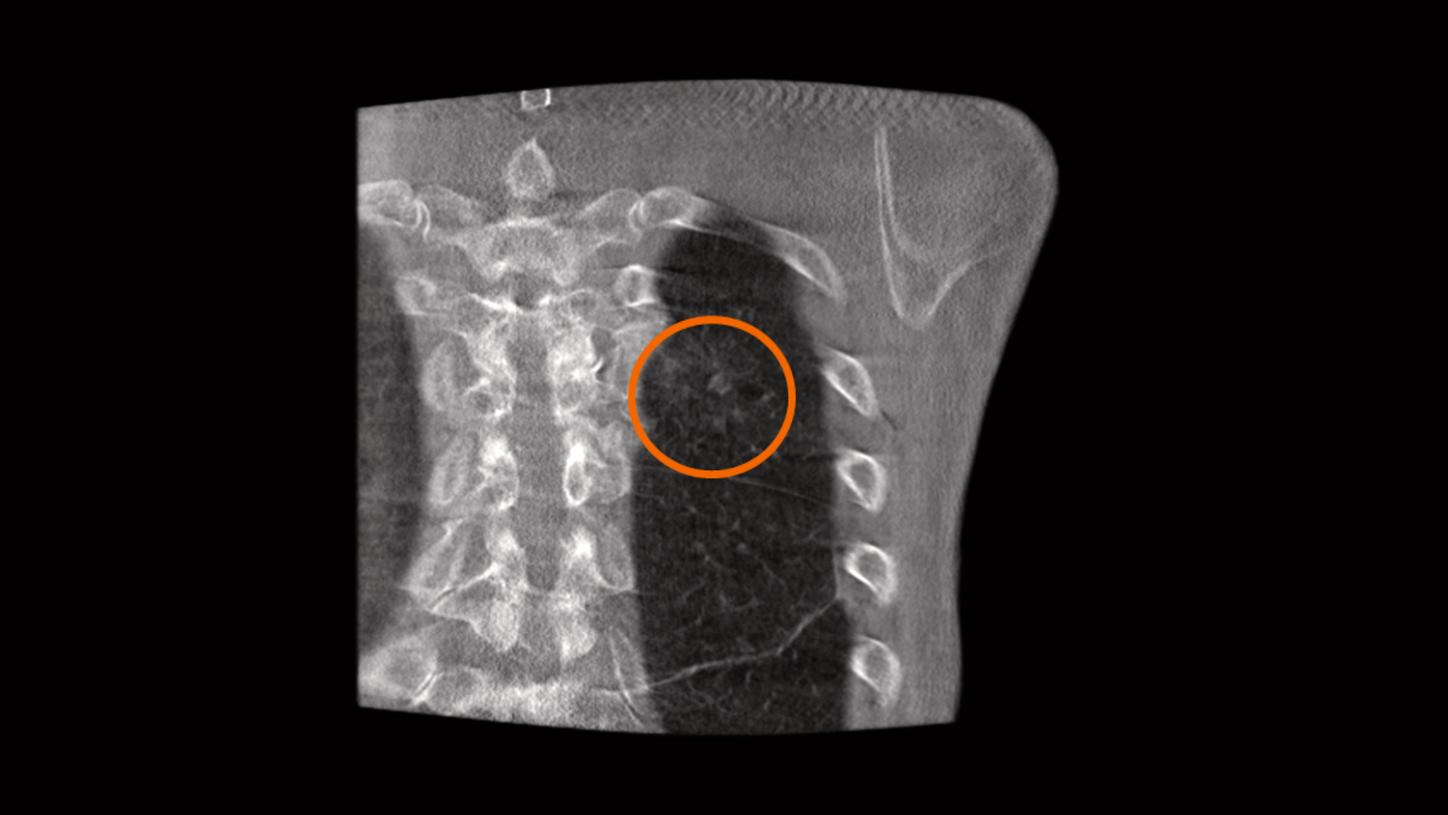 Clinical image showing verification that the tumor is completely covered by the ablation zone