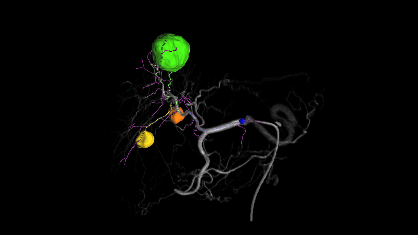 myEmbolization Guide