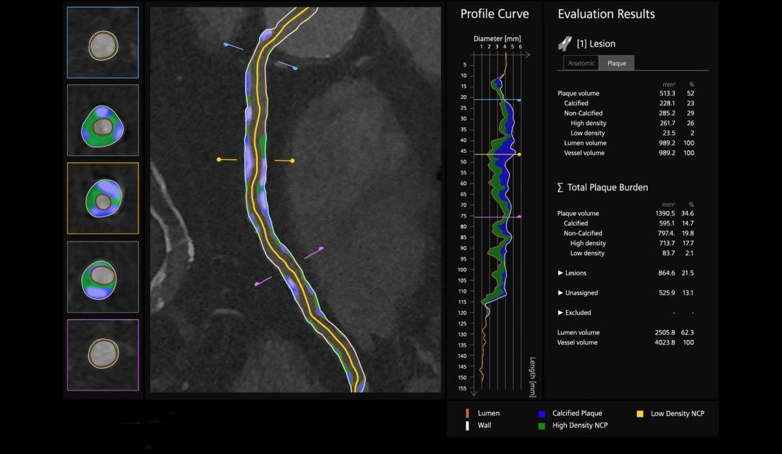 To further enhance diagnostic confidence, Syngo.CT Coronary Cockpit characterizes both the amount and the morphology of coronary plaque through AI-based segmentation, labeling, and visualisation.