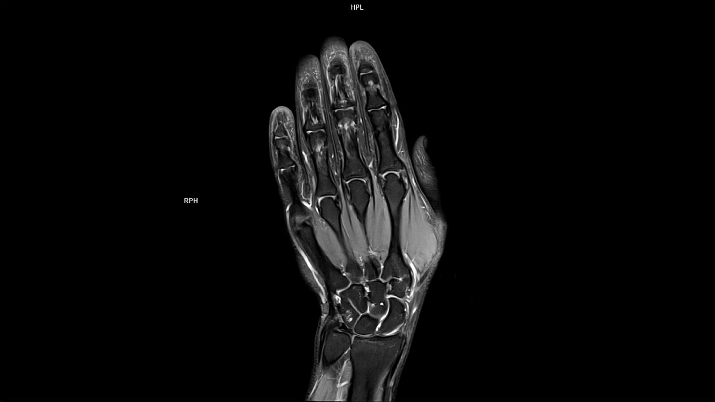 PD Cor FS DR Boost High Resolution-MAGNETOM Lumina/Coil-Hand Wrist 16/Resolution-.2 X .2 X 2/Scan Time-1:44/Aceleration-p3