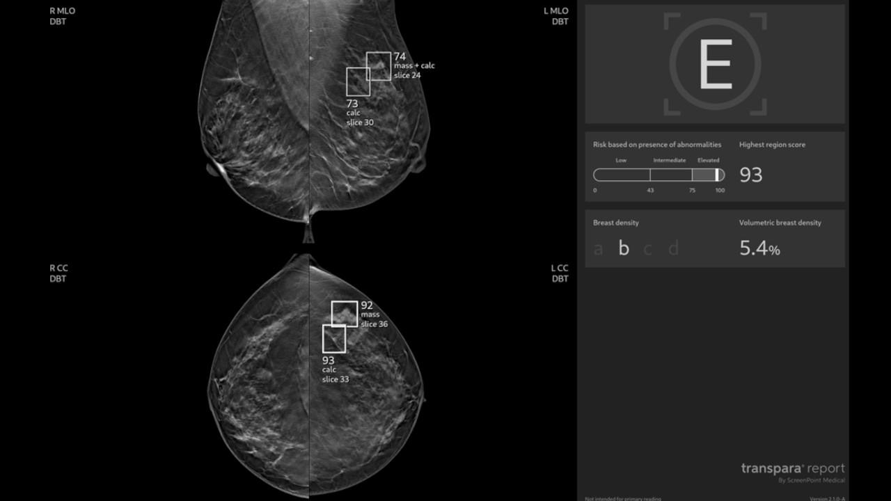AI in breast imaging
