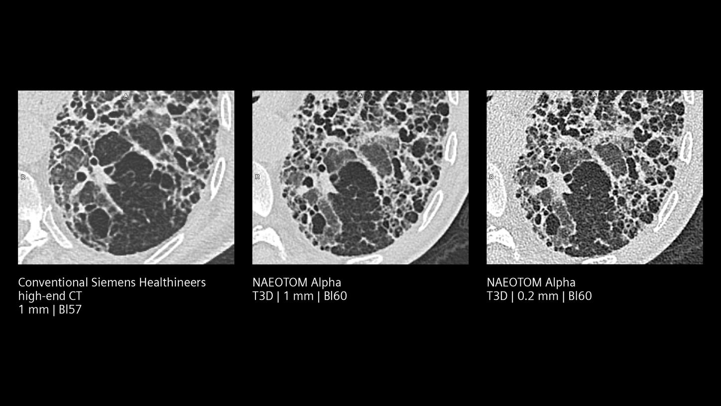 Comparison of conventional CT and NAEOTOM Alpha PCCT: Quantum HD resolution for lung fibrosis visualizes high details at low dose.