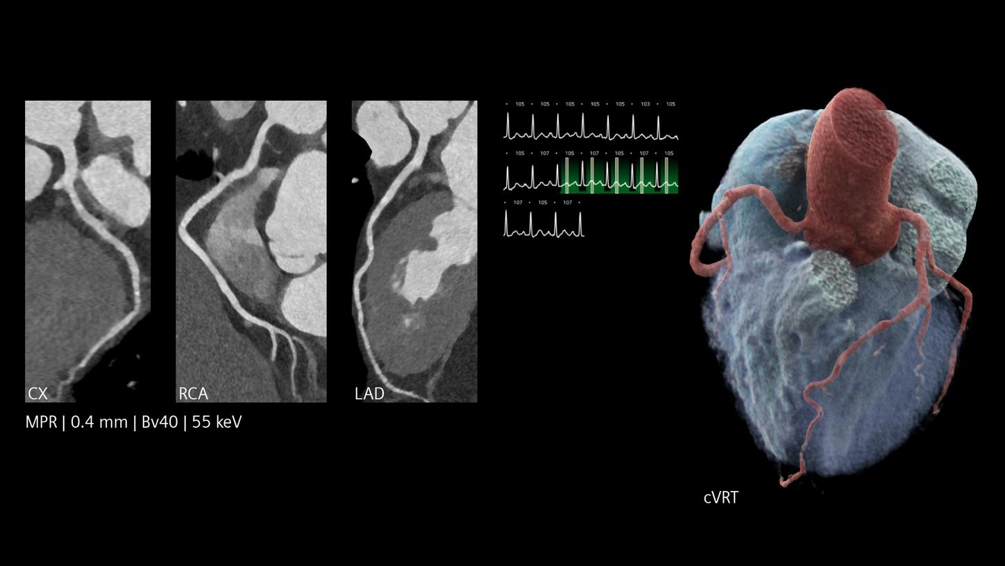 Cardiac CT images with labeled arteries, 3D heart model, and ECG trace showing heart rate of 106 bpm.