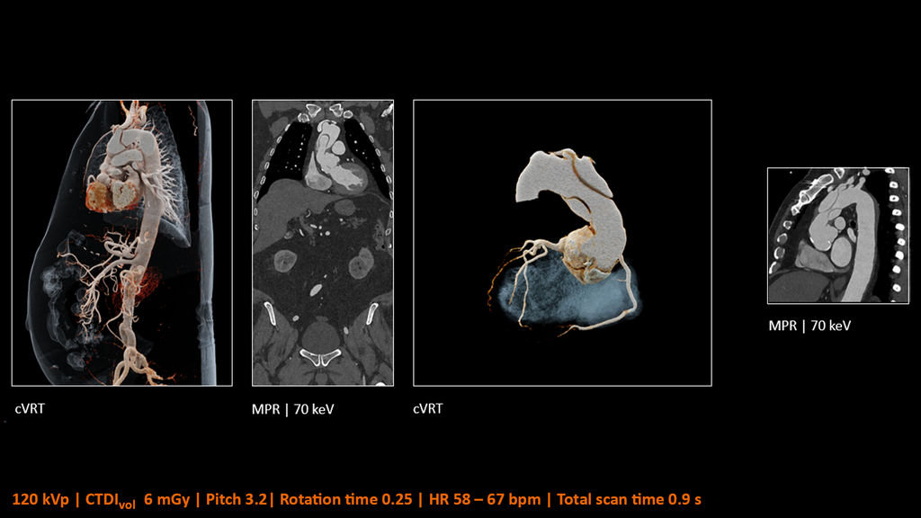 Dual Source CT - Siemens Healthineers