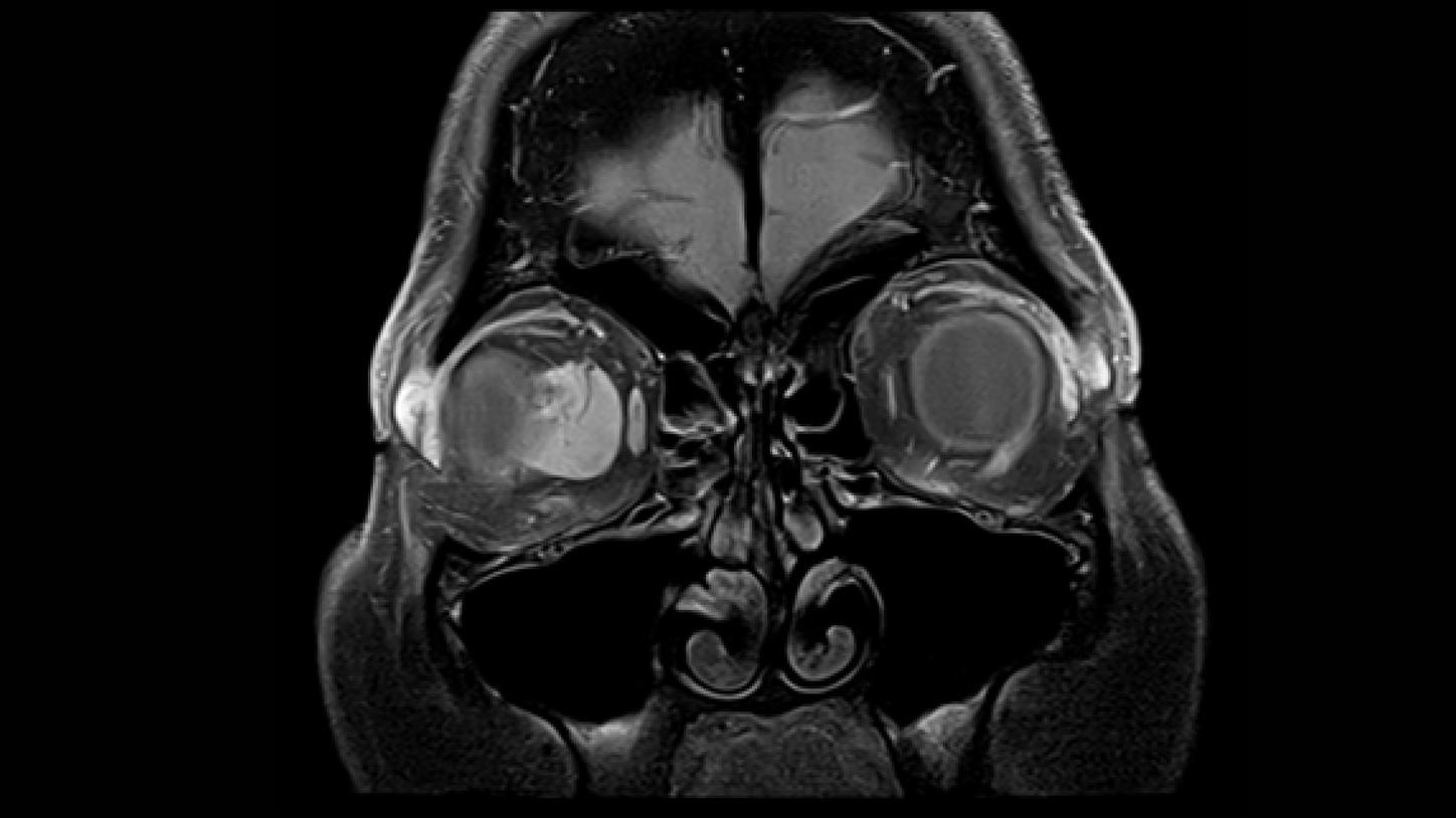 meningioma óptico