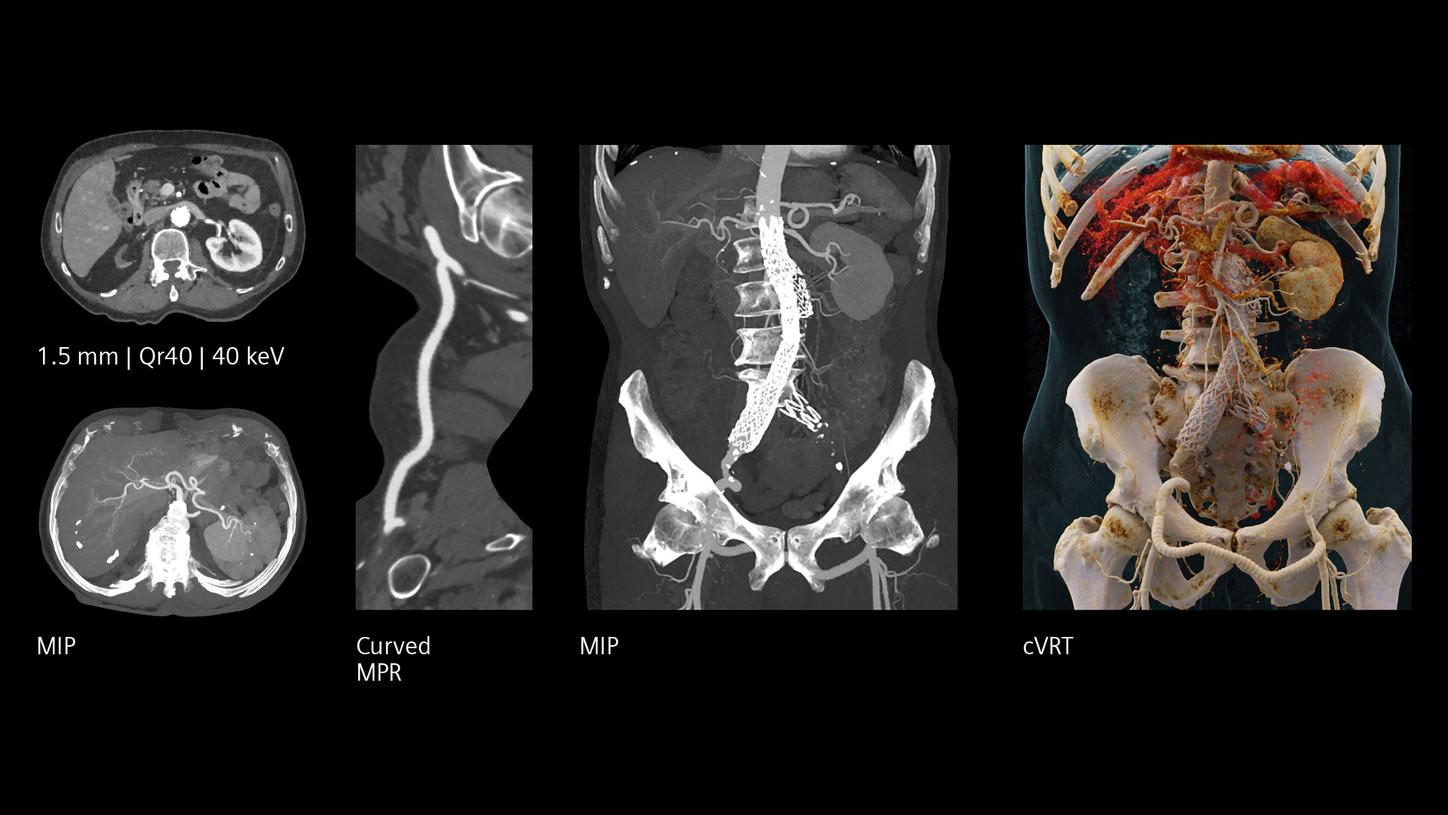 MIP, curved MPR, and cVRT clinical images visualized aortic stent bypass in high spatial resolution.
