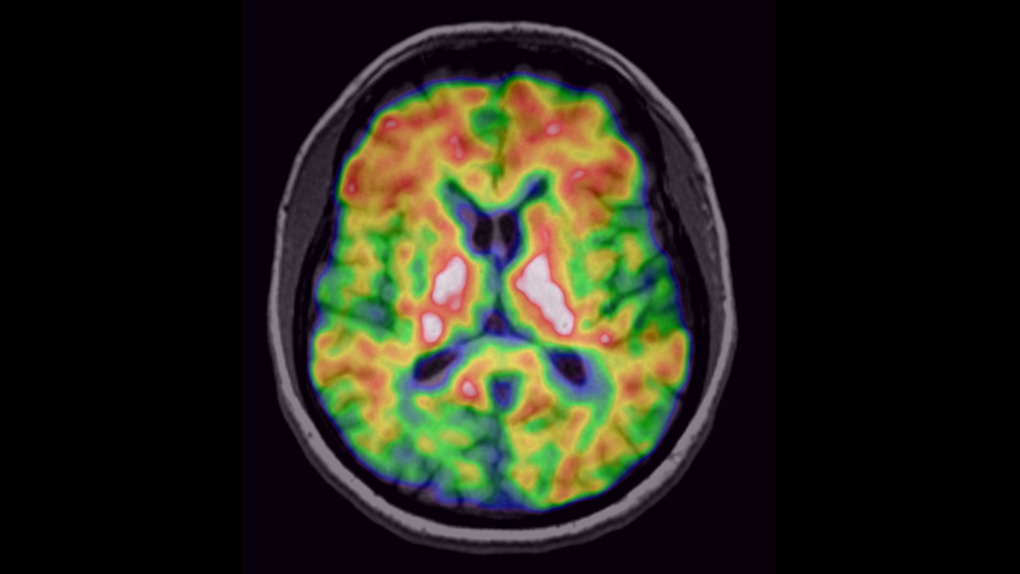 Clinical image of brain with Alzheimer 