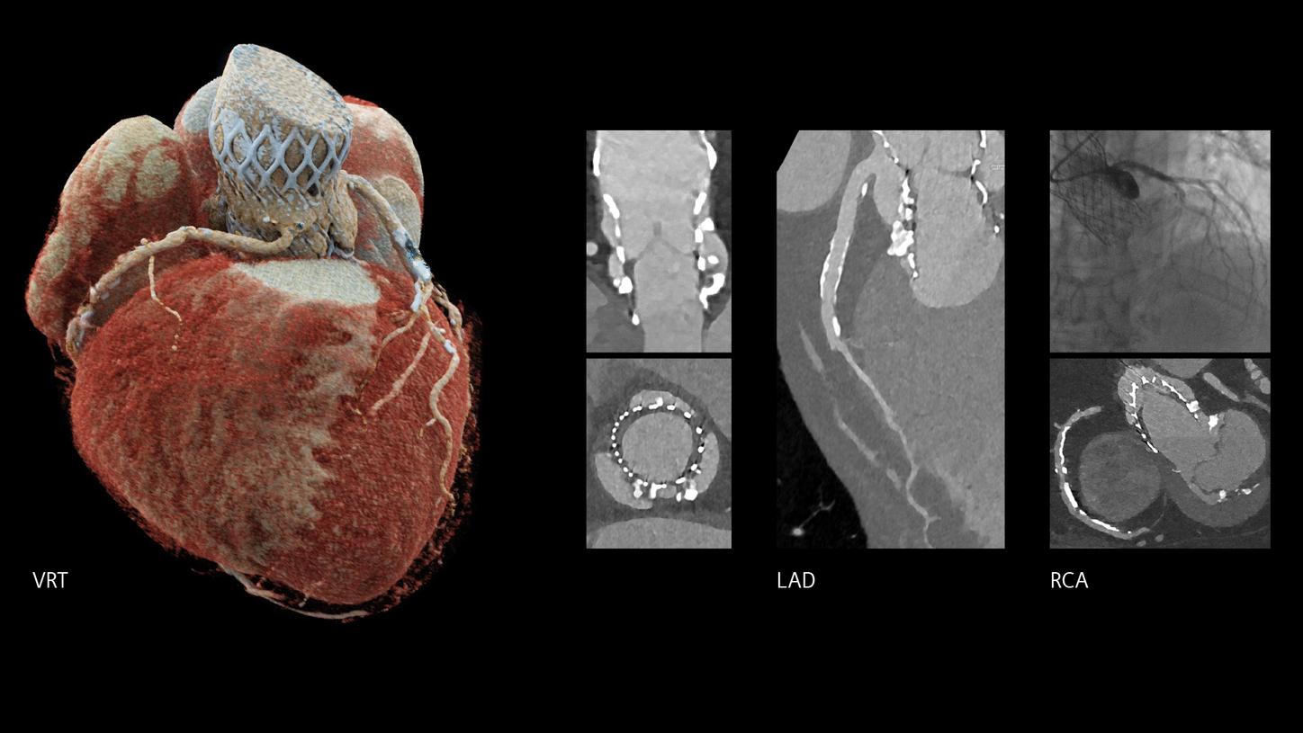 Clinical images of a Quantum HD Cardiac assessment of prosthetic valves, VRT, LAD and RCA views.