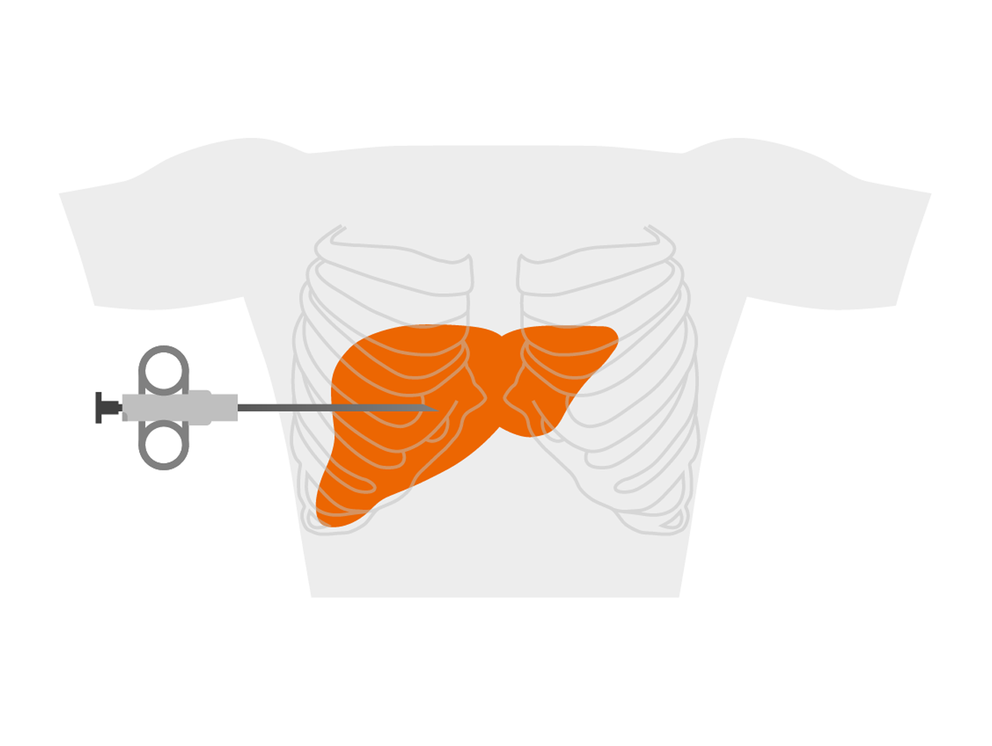 ELF Test Revolutionizing Liver Health Assessment by Optimizing Care  Pathway to Hepatology Clinics