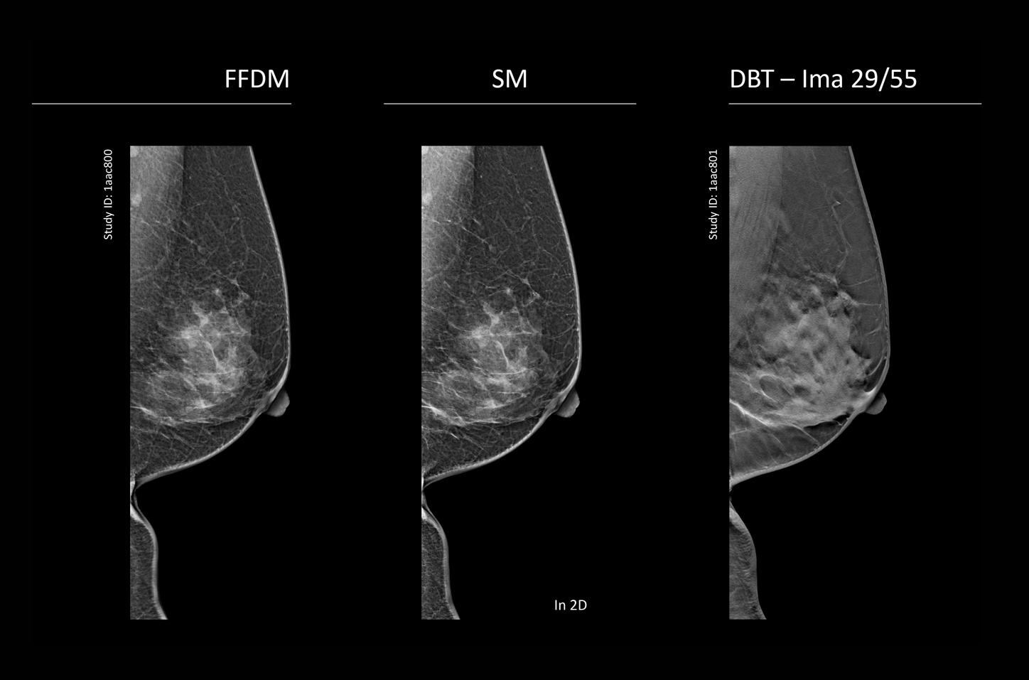 CT image of retro-ocular masses causing exophthalmos along with bilateral perinephric, pericardial, and pelvic exudates