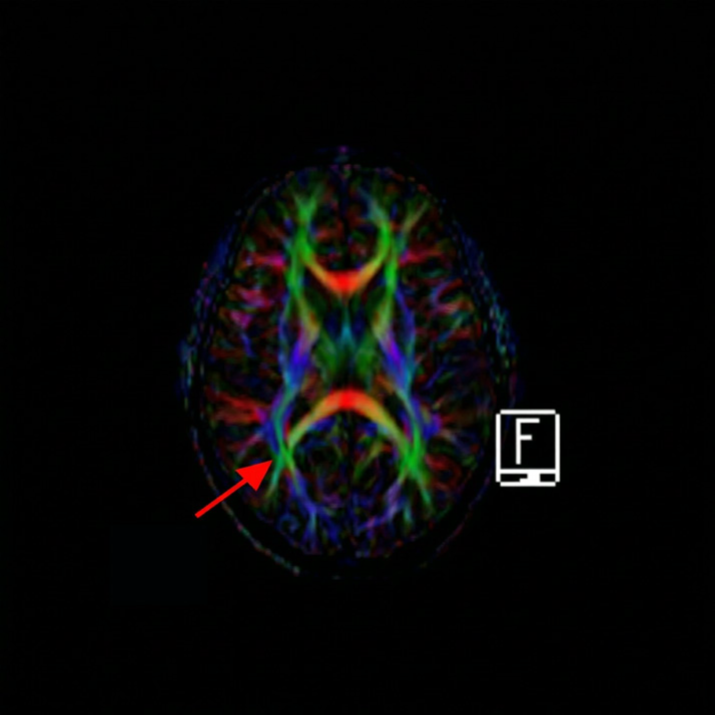 Fig G - MRI