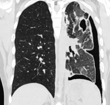 chest radio
