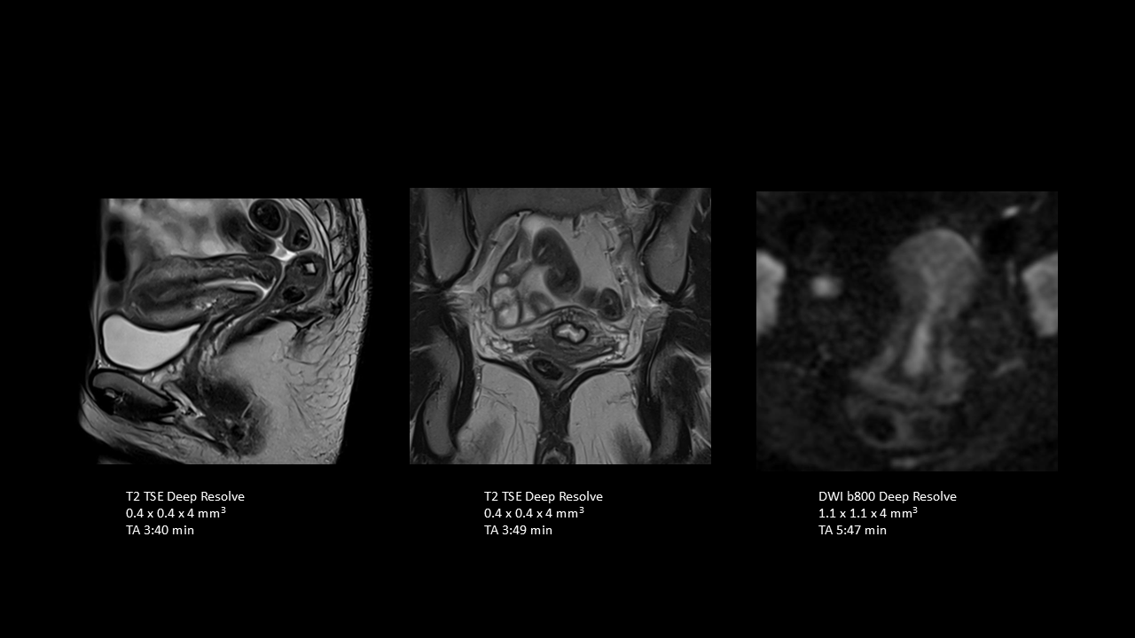 Sagittal T2 and DWI for gynecology imaging   