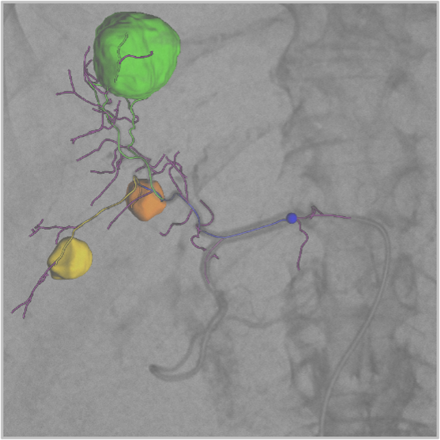 embolization guidance