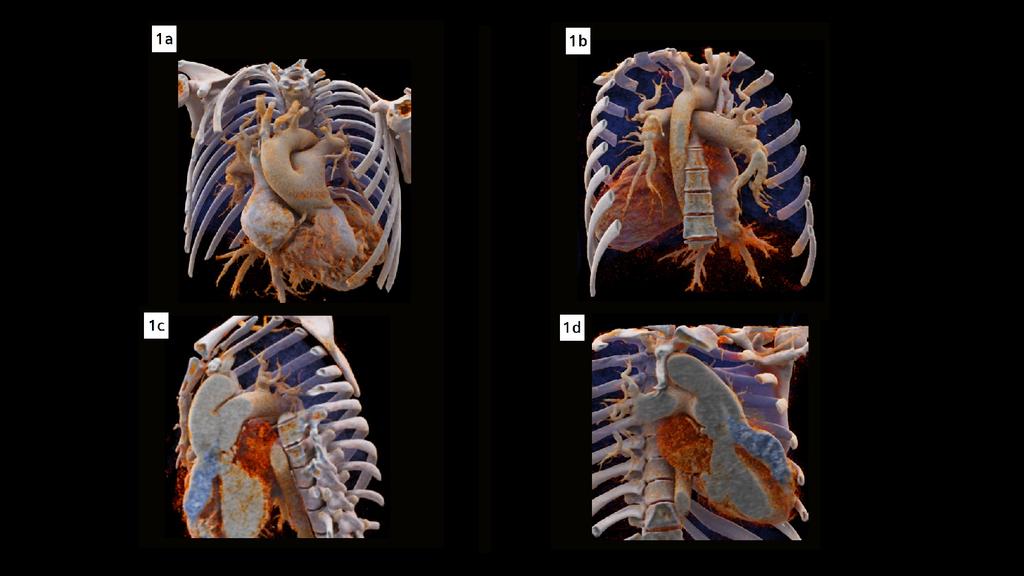 Unrepaired persistent truncus arteriosus in an adult - Siemens ...