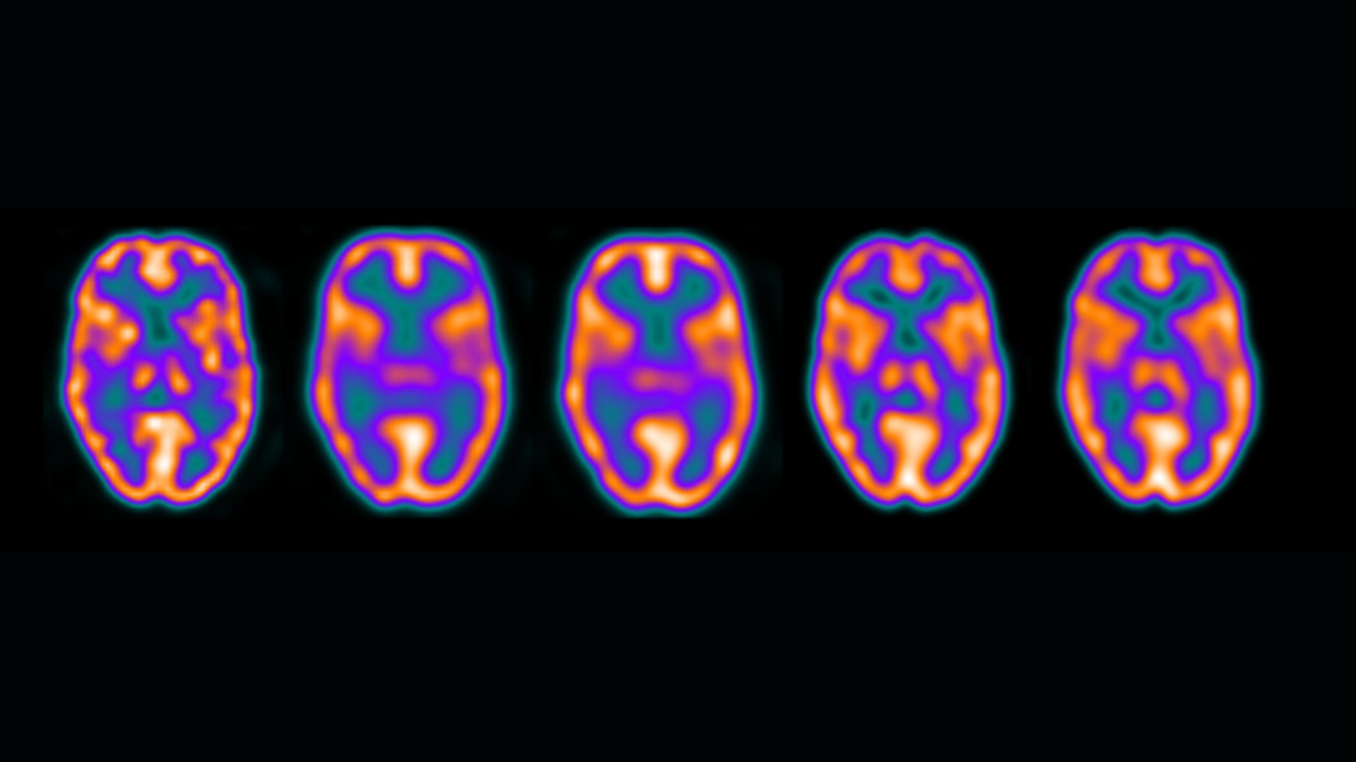 SMARTZOOM HRX: Applications and benefits in SPECT and SPECT/CT brain ...
