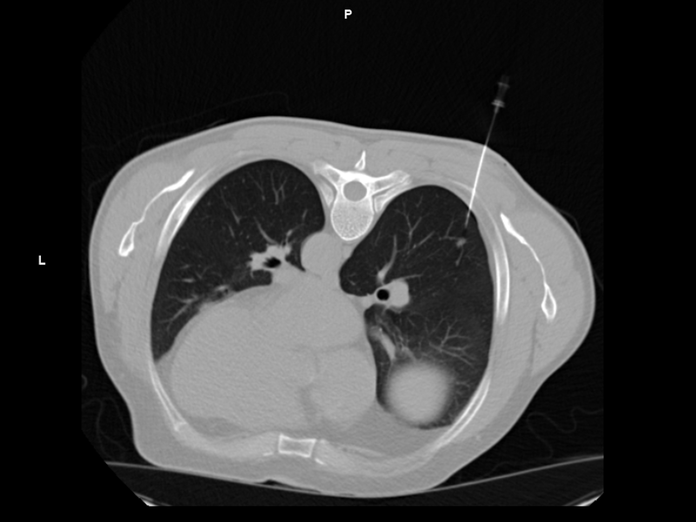 CT image-guided lung biopsy using SOMATOM X.cite and myNeedle Guide; Axial view; i-Sequence