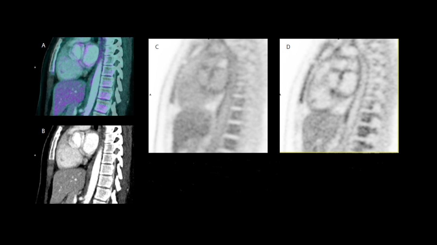 Example of an endometriosis research protocol of a patient in their mid 30s for assessment of the cardiac walls. Administered dose of 3.5 MBq/kg of 18F-FDG.2, 3 Images were acquired with a scan time of 10 minutes.