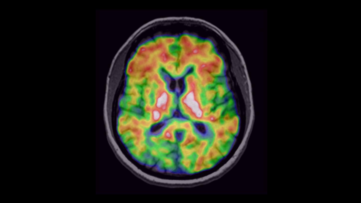 Clinical image of brain with Alzheimer